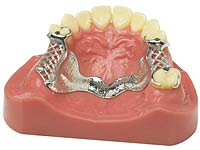 Cast Partials - Diamond Dental Lab